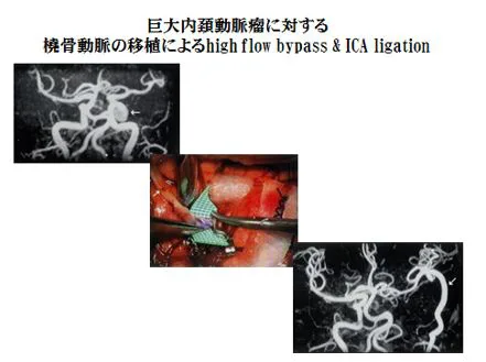 過去に行った困難な手術 | 氏家脳神経外科内科クリニック